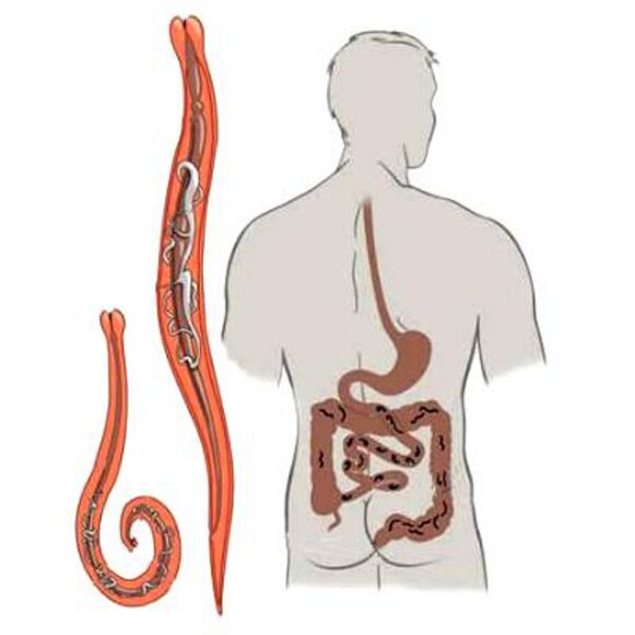 Gusanos en el cuerpo humano